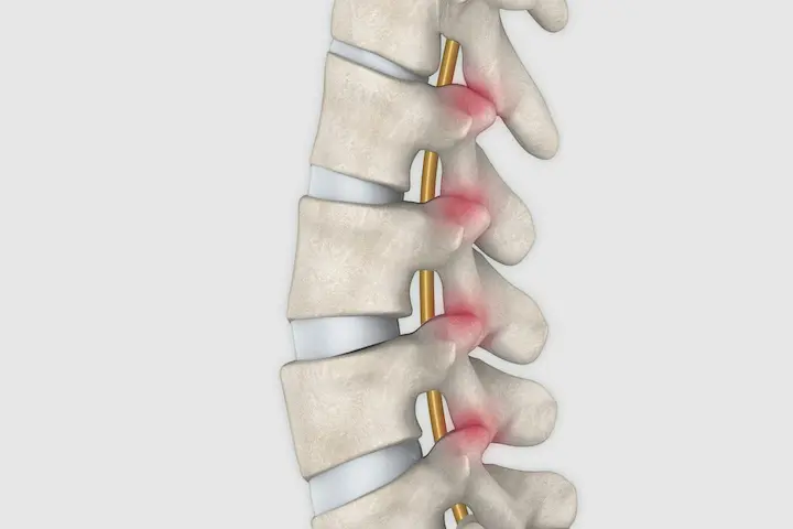 Facettensyndrom Schematische Darstellung